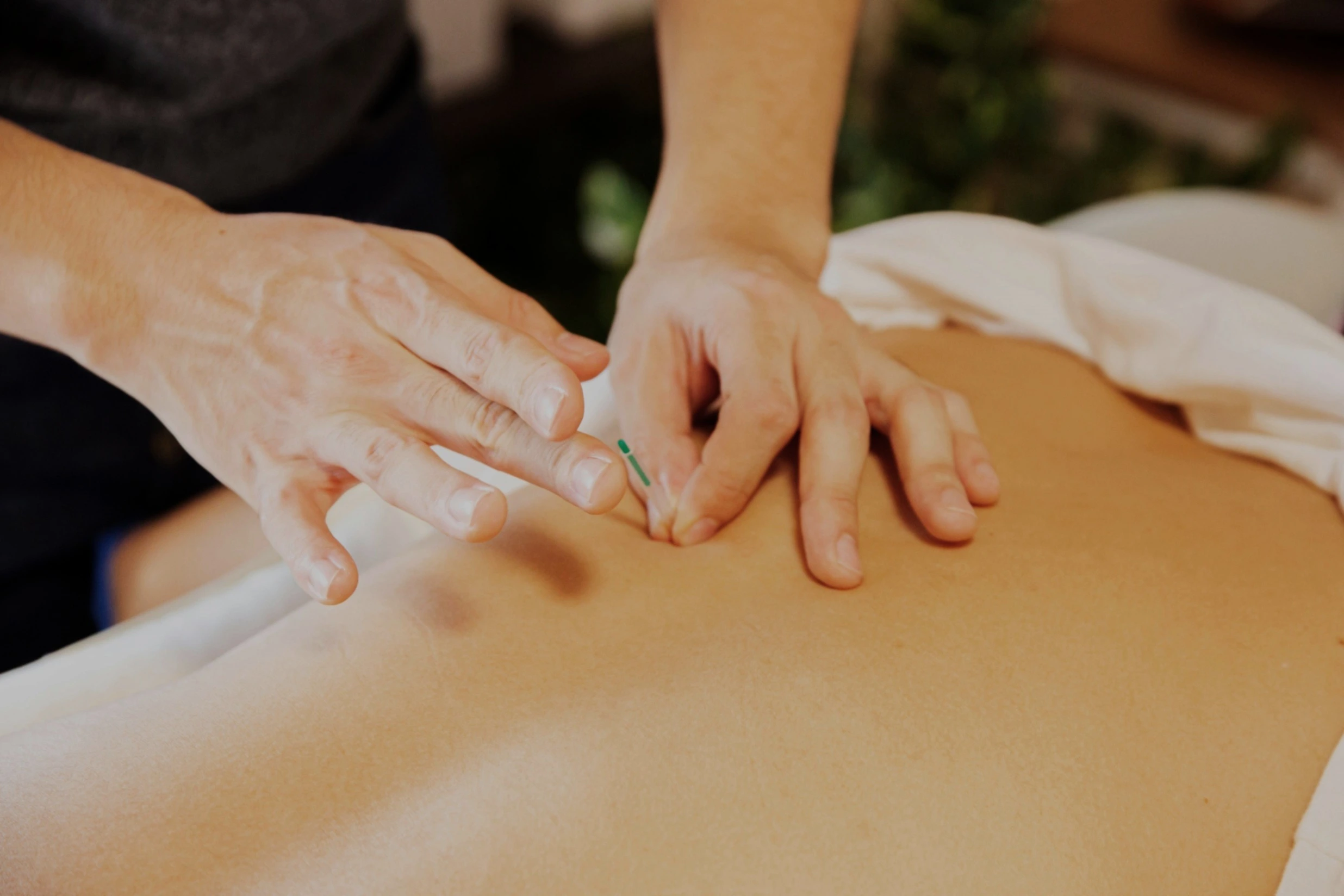 A person having acupuncture treatment to their back