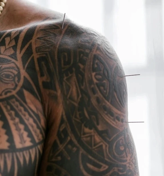 man with a shoulder tattoo having shoulder traditional chinese medicine acupuncture